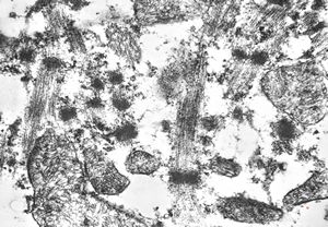 F,75y. | rhabdomyoma - tongue